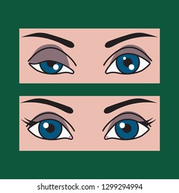 Ptosis of eyelid at woman, asymmetry of eyes, plastic surgery, operating correction of ptosis eyes girls. Vector illustration before and after