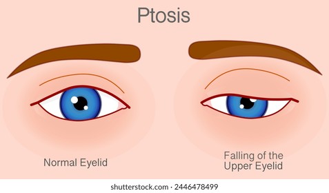 Ptosis, falling eye upper eyelid droop over eye. Droopy, lazy eye. Skin color back. Vector illustration