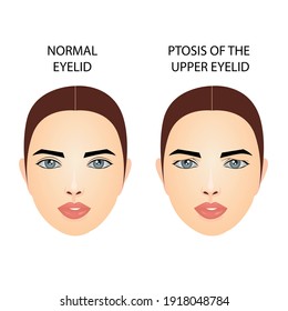 Ptosis of the upper eyelid, medical vector illustration