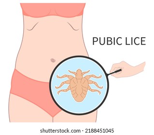 Pubic Lice Tiny Bed Bugs Tick Egg Infection Body