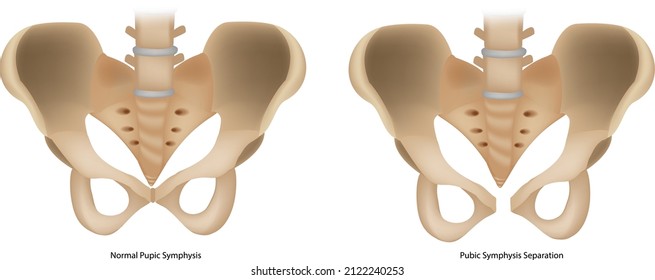 Pubic Symphysis Separation or SPD. Symphysis Pubis Dysfunction and Normal Pupic Symphysis.