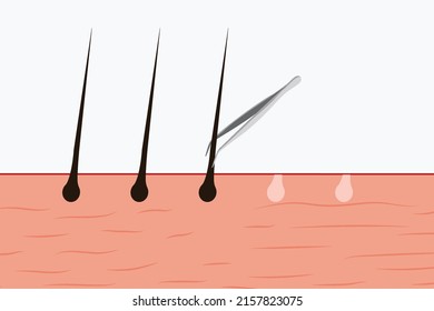 Pulling out body hair with a tweezer vector. Using a tweezer to pull out body hair from the skin. Skin vector illustration with hair and a tweezer. Hair removal concept from the skin.