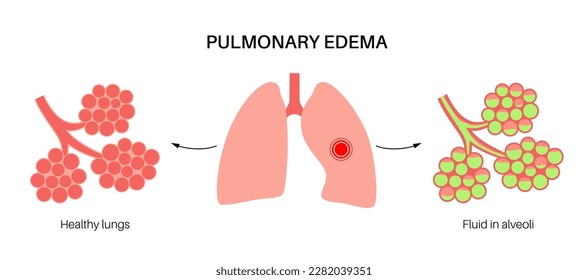 Pulmonary edema anatomical poster. Abnormal fluid in lungs. Inflammation in the human respiratory system. Alveoli with fluid. Purulent material in the chest. Shortness of breath and causes of cough