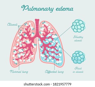 Pulmonary Edema Anatomical Scheme Hand Drawn Stock Vector (Royalty Free ...