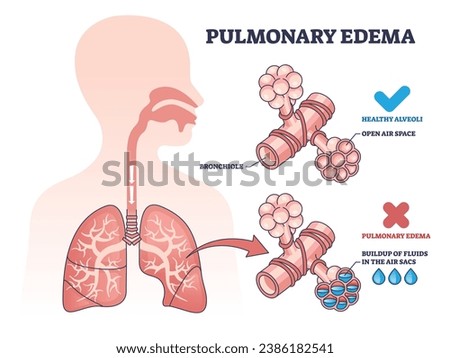 Pulmonary edema condition with fluid buildup in air sacs outline diagram. Labeled educational scheme with healthy and disease lungs medical comparison vector illustration. Respiratory bronchiole care