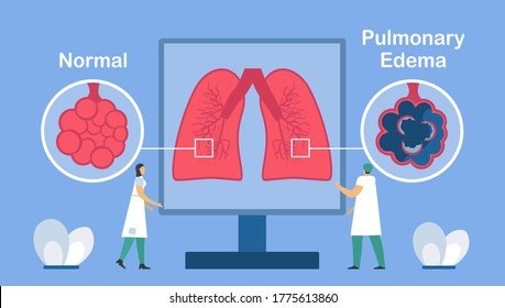 Pulmonary edema is shown good and bad alveoli. Other names is lung congestion, lung water, and pulmonary congestion. Body struggles to get enough oxygen until shortness of breath.