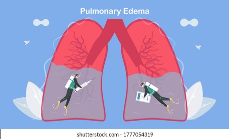 Pulmonary Edema Is Symptom That Lungs Fill With Fluid. Treatment And Diagnostic. Body Struggles To Get Enough Oxygen Until Shortness Of Breath.