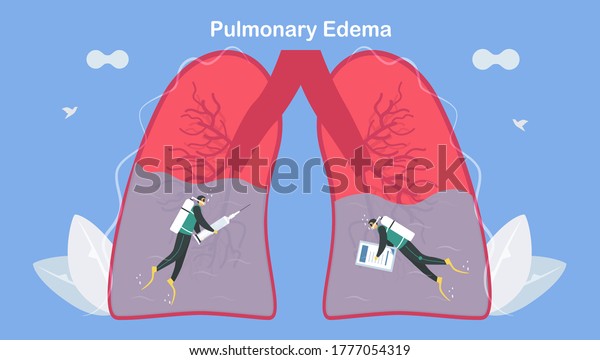 Pulmonary Edema Symptom That Lungs Fill Stock Vector (Royalty Free ...