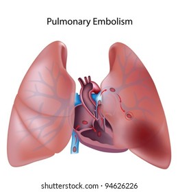 Pulmonary Embolism