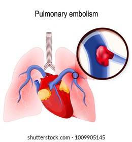 Pulmonary Embolism. Blockage Of The Main Artery Of The Lung Or One Of Its Branches By A Blood Clot. Human Lungs And Heart. Blood Clot In The Vein (close- Up)