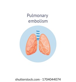 Pulmonary Embolism Or Blockage Of The Main Artery Of The Lung By A Blood Clot Medical Educational Scheme Or Diagram, Vector Illustration Isolated On White Background.