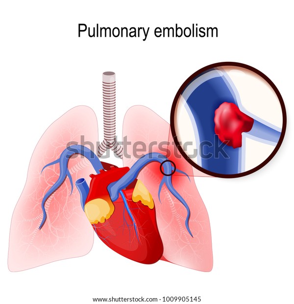 肺栓塞通过血块堵塞肺部或其一个分支的主动脉 人类肺部和心脏 血液凝块在静脉 关闭 库存矢量图 免版税