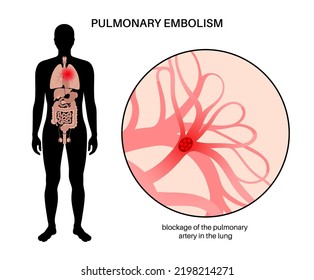 Pulmonary Embolism Disease. Deep Vein Thrombosis In Male Body. Blood Clot In Lung Vein Anatomical Poster. Blocking Blood Flow In Lungs. Circulatory System Problem. DVT Medical Flat Vector Illustration