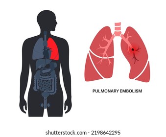 Pulmonary Embolism Disease. Deep Vein Thrombosis In Male Body. Blood Clot In Lung Vein Anatomical Poster. Blocking Blood Flow In Lungs. Circulatory System Problem. DVT Medical Flat Vector Illustration