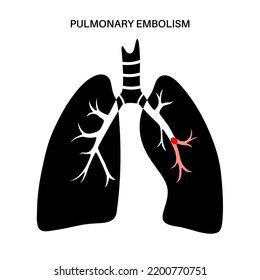 Pulmonary Embolism Disease Deep Vein Thrombosis Stock Vector (Royalty ...