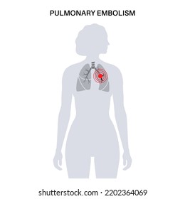 Pulmonary Embolism Disease. Deep Vein Thrombosis In The Female Body. Blood Clot In Lung Vein Anatomical Poster. Blocking Blood Flow In Lungs. Circulatory System Problem. DVT Flat Vector Illustration