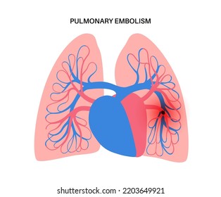 Pulmonary Embolism Disease. Deep Vein Thrombosis. Blood Clot In Lung Vein Close Up Anatomical Poster. Blocking Blood Flow In Lungs. Circulatory System Problem. DVT Medical Flat Vector Illustration