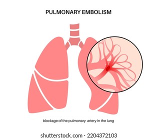 Pulmonary Embolism Disease. Deep Vein Thrombosis. Blood Clot In Lung Vein Close Up Anatomical Poster. Blocking Blood Flow In Lungs. Circulatory System Problem. DVT Medical Flat Vector Illustration