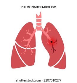 Pulmonary Embolism Disease. Deep Vein Thrombosis. Blood Clot In Lung Vein Close Up Anatomical Poster. Blocking Blood Flow In Lungs. Circulatory System Problem. DVT Medical Flat Vector Illustration