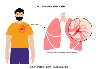 Pulmonary Embolism Disease. Deep Vein Thrombosis In Male Cartoon Body. Blood Clot In Lung Vein Anatomical Poster. Blocking Blood Flow In Lungs. Circulatory System Problem. DVT Vector Illustration