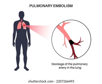 Pulmonary Embolism Disease. Deep Vein Thrombosis In Male Body. Blood Clot In Lung Vein Anatomical Poster. Blocking Blood Flow In Lungs. Circulatory System Problem. DVT Medical Flat Vector Illustration