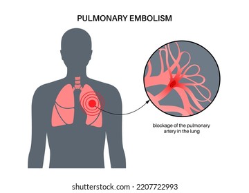 Pulmonary Embolism Disease. Deep Vein Thrombosis In Male Body. Blood Clot In Lung Vein Anatomical Poster. Blocking Blood Flow In Lungs. Circulatory System Problem. DVT Medical Flat Vector Illustration