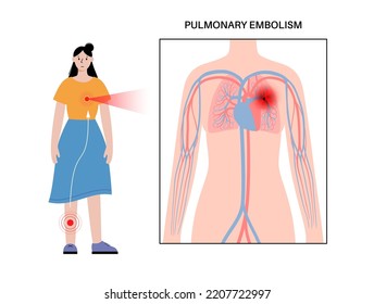 Pulmonary Embolism Disease. Deep Vein Thrombosis In Female Cartoon Body. Blood Clot In Lung Vein Anatomical Poster. Blocking Blood Flow In Lungs. Circulatory System Problem. DVT Vector Illustration