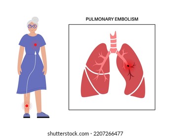 Pulmonary Embolism Disease. Female Mature Patient. Old Age Lady With Deep Vein Thrombosis. Blood Clot In Lung Vein. Blocking Blood Flow In Lungs. Circulatory System Problem. DVT Vector Illustration