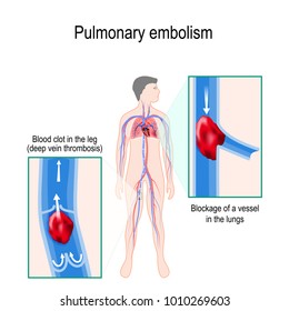 Pulmonary Embolism. Human Silhouette With Highlighted Circulatory System. Close-up: Blood Clot In The Leg (deep Vein Thrombosis), And Blockage Of A Vessel In The Lungs