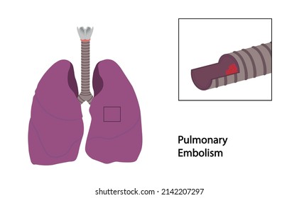 Pulmonary Embolism Illustration. Lung Bronchi With A Blood Clot. 