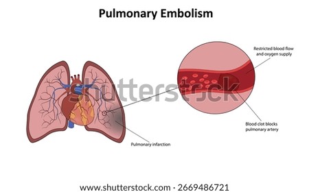 Pulmonary embolism in lungs vector illustration