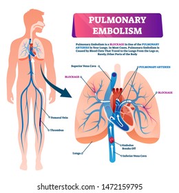 Pulmonary Veins Images Stock Photos Vectors Shutterstock