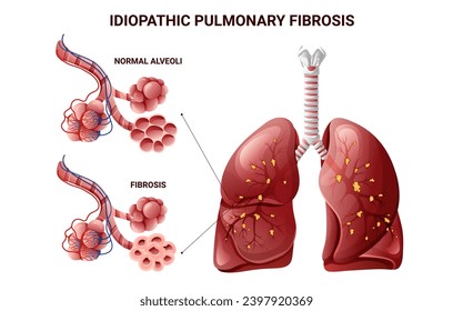 Pulmonary fibrosis alveoli structure. Vector illustration isolated on white background, cartoon style
