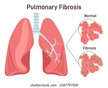 Pulmonary Fibrosis. Lung Tissue Disease. Damaged, Thickened, Stiff Tissue. Anatomy Of Human Body, Respiratory System Studying. Flat Vector Illustration