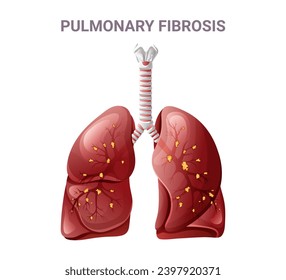 Pulmonary fibrosis and normal lung. Vector illustration isolated on white background, cartoon style
