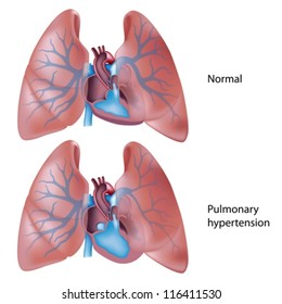 Pulmonary Hypertension