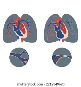 Pulmonary Hypertension. Diagram With Changes In The Heart And Arteries. Medical Poster. Vector Illustration