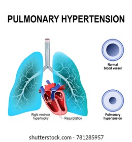 Pulmonary Hypertension Is An Increased Blood Pressure Within The Arteries Of The Lungs. Cross Section Of The Normal, And Narrowing Of Blood Vessels. Humans Heart With Hypertrophy Of Right Ventricle