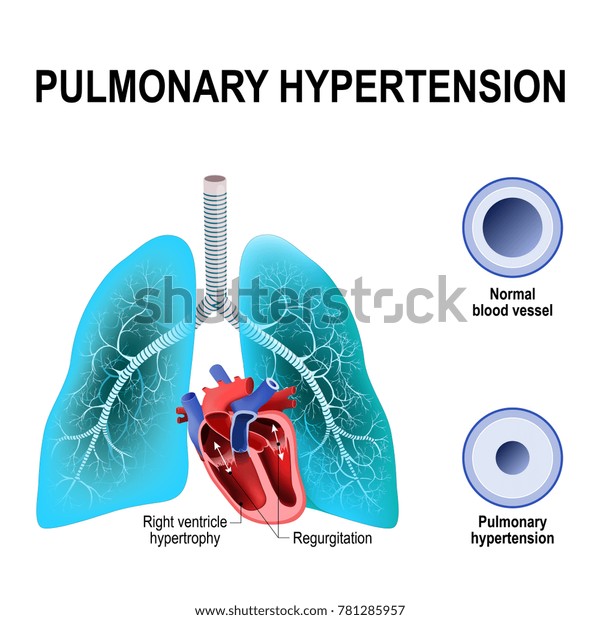 Hipertensión arterial pulmonar pulmonar Hipertensión arterial pulmonar pulmonar