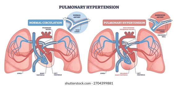 La hipertensión pulmonar en general, que compara el flujo normal con el flujo de alta presión, que incluye los pulmones, el corazón y la arteria pulmonar, muestra una luz estrecha y una distensión del ventrículo derecho. Esquema del diagrama