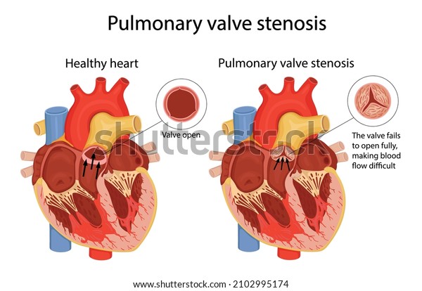 pulmonary valve\
stenosis. anatomical\
illustration