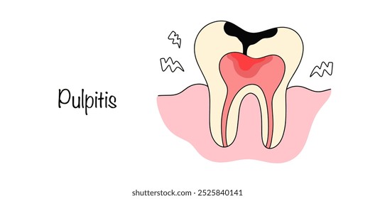 Pulpitis. A disease associated with the process of inflammation in the pulp inside the tooth. Tooth with pulpitis for use in dentistry. Vector illustration.