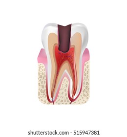 Pulpitis. Inflamed pulp tissue. Vector illustration.