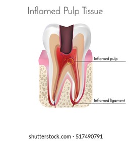 Pulpitis. Inflamed Pulp Tissue. Vector Illustration.