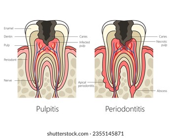 Pulpitis and periodontitis in human teeth diagram schematic vector illustration. Medical science educational illustration