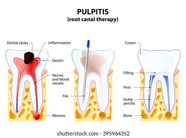 Pulpitis. root canal therapy. Infected pulp is removed from the tooth and the space occupied by it is cleaned and filled with a gutta percha. Post inserted to support crown