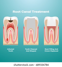 Pulpitis. Root Canal Therapy. Infected Pulp Is Removed From The Tooth And The Space Occupied By It Is Cleaned And Filled With A Gutta Percha Isolated On A Background. Vector Illustration. Stomatology