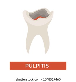 Pulpitis tooth decay caries stage dentistry and dental health vector medicine and healthcare oral cavity disease or illness symptom toothache damaged teeth removal procedure periodontitis development