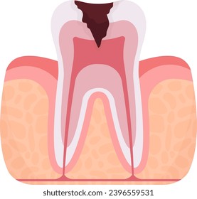 Ilustración del vector de problemas dentales de pulpitis