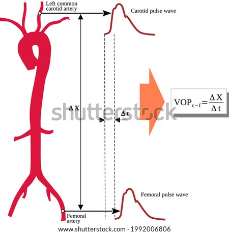 Pulse Wave Velocity (PWV) is a measure of arterial stiffness and is defined the velocity at which the blood pressure pulse wave propagates through the circulatory system